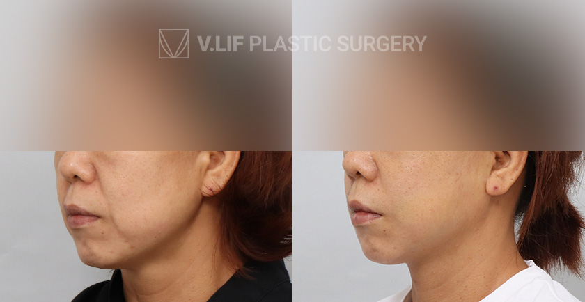 Thread Lift before and after — Vlif Plastic surgery