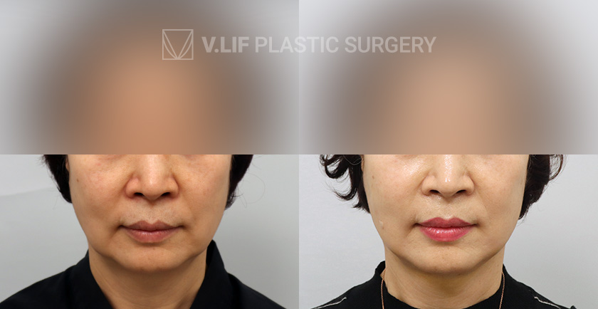 Thread Lift before and after — Vlif Plastic surgery