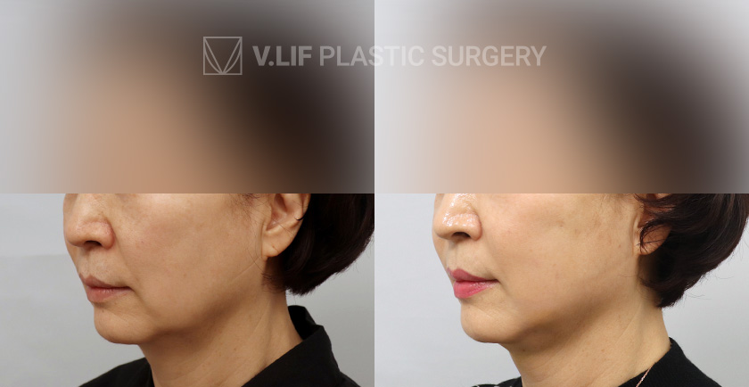 Thread Lift before and after — Vlif Plastic surgery