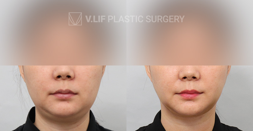 Thread Lift before and after — Vlif Plastic surgery