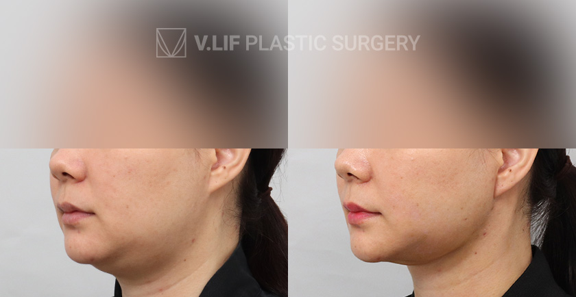 Thread Lift before and after — Vlif Plastic surgery