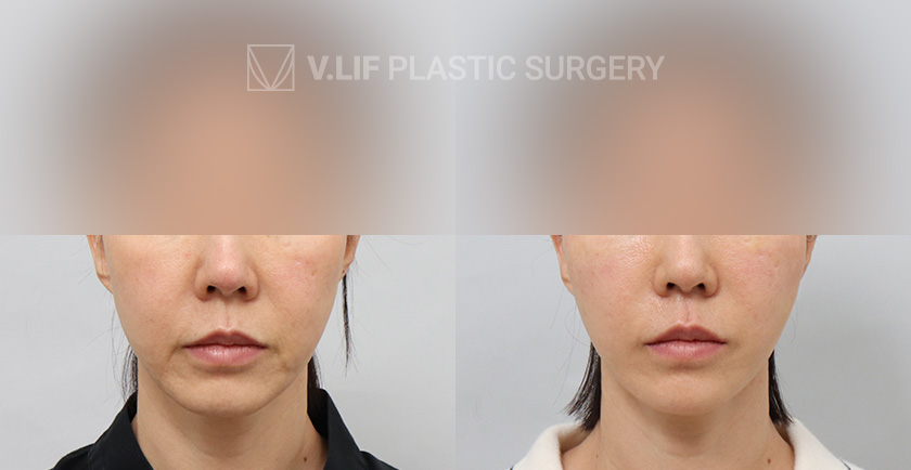 Thread Lift before and after — Vlif Plastic surgery