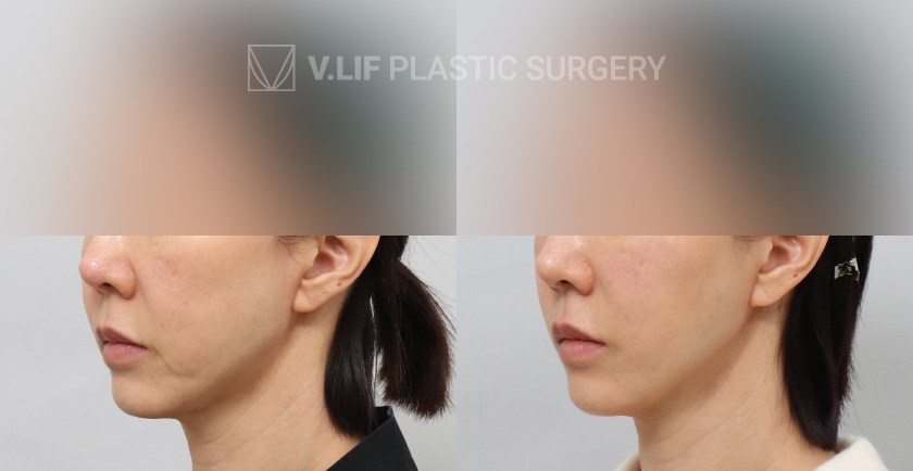 Thread Lift before and after — Vlif Plastic surgery