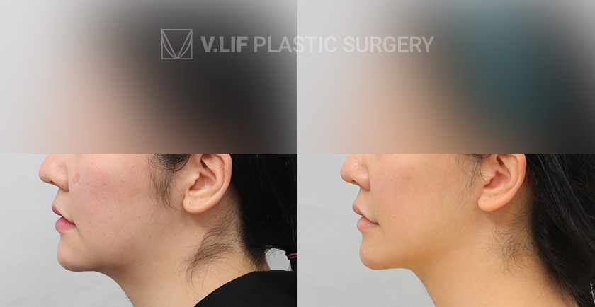 Mini Lift before and after — Vlif Plastic surgery