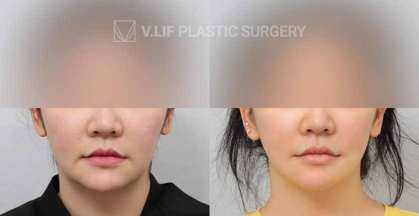 Mini Lift before and after — Vlif Plastic surgery