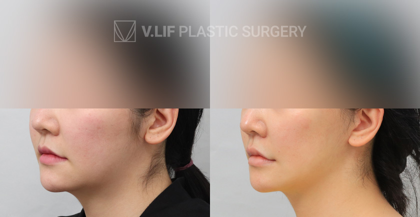 Mini Lift before and after — Vlif Plastic surgery