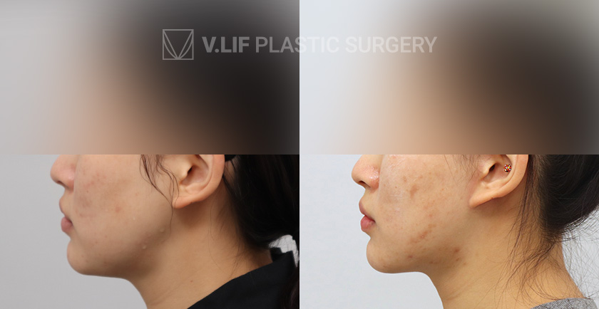 Mini Lift before and after — Vlif Plastic surgery