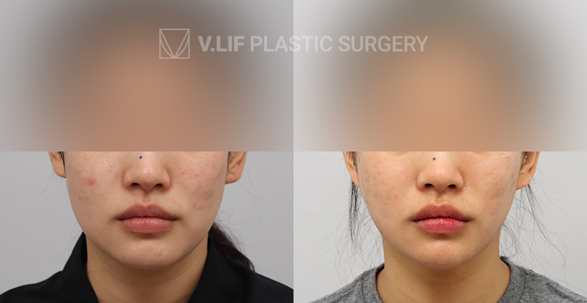 Mini Lift before and after — Vlif Plastic surgery