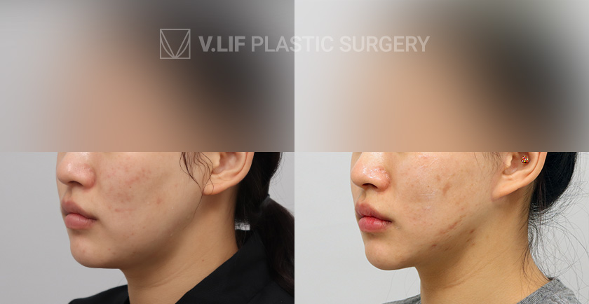 Mini Lift before and after — Vlif Plastic surgery