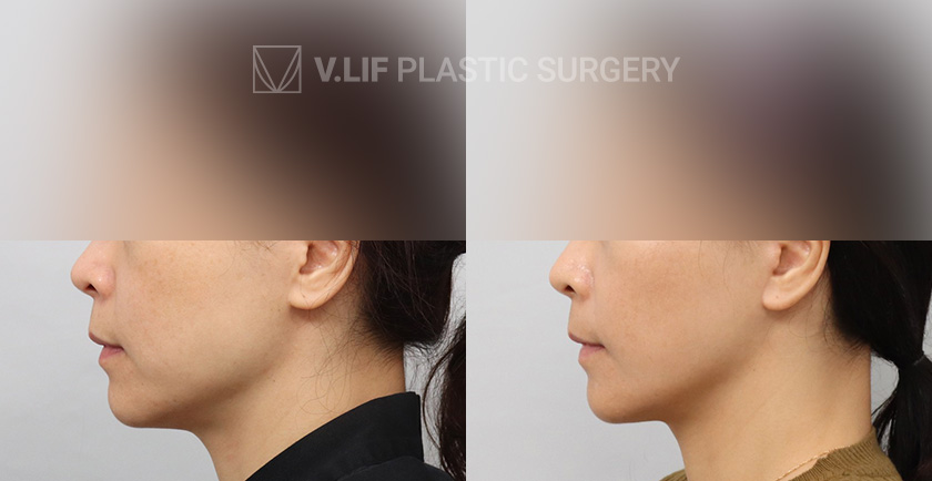 Mini Lift before and after — Vlif Plastic surgery