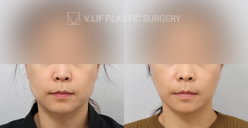 Mini Lift before and after — Vlif Plastic surgery