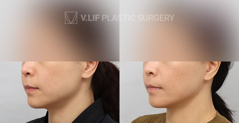 Mini Lift before and after — Vlif Plastic surgery