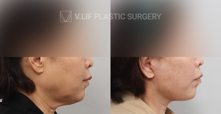 Face Neck Lift Platysma Plication before and after — Vlif Plastic surgery