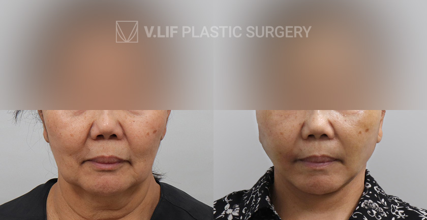 Face Neck Lift before and after — Vlif Plastic surgery
