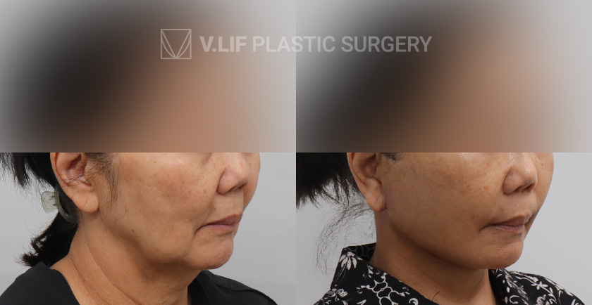 Face Neck Lift before and after — Vlif Plastic surgery