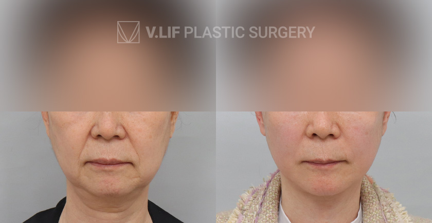 Face Neck Lift Platysma Plication before and after — Vlif Plastic surgery