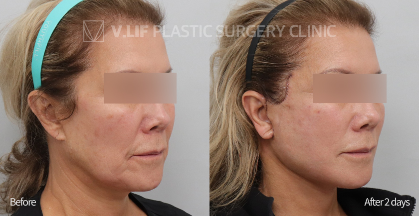 Revision Facelift before and after — Vlif Plastic surgery