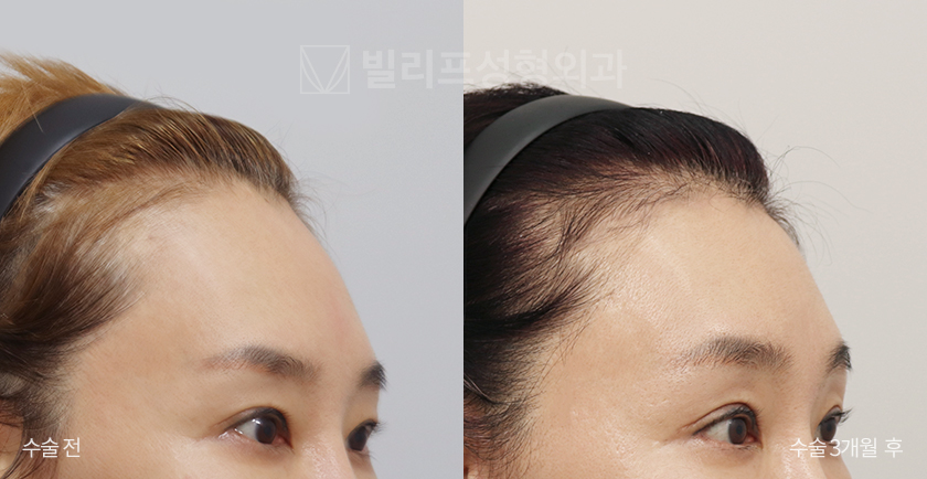 Endoscopic Forehead Lift (Endotine) before and after — Vlif Plastic surgery