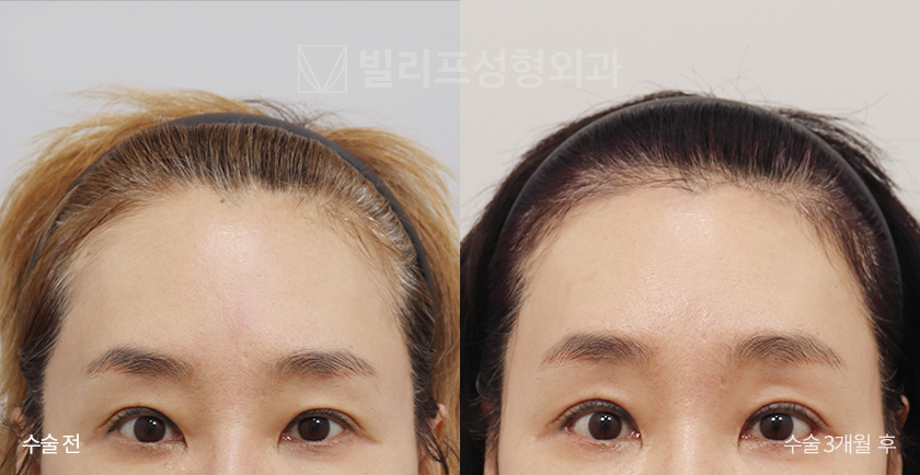 Endoscopic Forehead Lift (Endotine) before and after — Vlif Plastic surgery