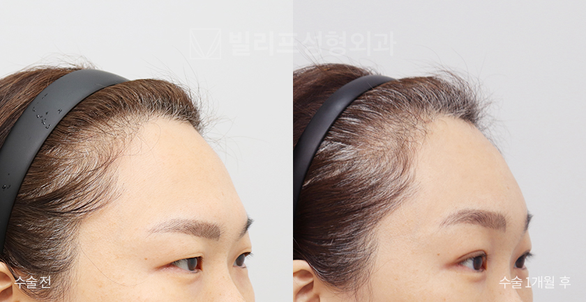 Endoscopic Forehead Lift (Endotine) before and after — Vlif Plastic surgery