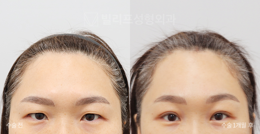 Endoscopic Forehead Lift (Endotine) before and after — Vlif Plastic surgery