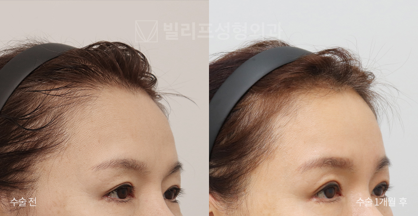 Endoscopic Forehead Lift (Bone Tunneling) before and after — Vlif Plastic surgery