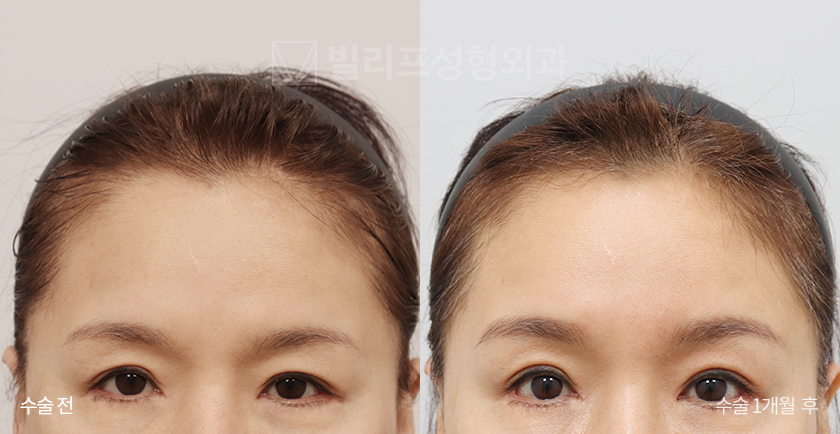 Endoscopic Forehead Lift (Bone Tunneling) before and after — Vlif Plastic surgery