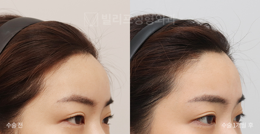 Endoscopic Forehead Lift (Bone Tunneling) before and after — Vlif Plastic surgery
