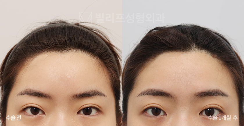 Endoscopic Forehead Lift (Bone Tunneling) before and after — Vlif Plastic surgery