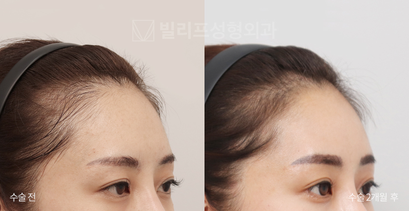 Endoscopic Forehead Lift (Endotine) before and after — Vlif Plastic surgery