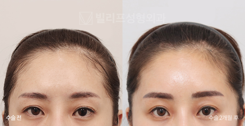 Endoscopic Forehead Lift (Endotine) before and after — Vlif Plastic surgery