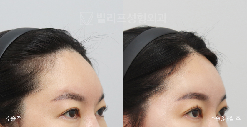 Endoscopic Forehead Lift (Endotine) before and after — Vlif Plastic surgery