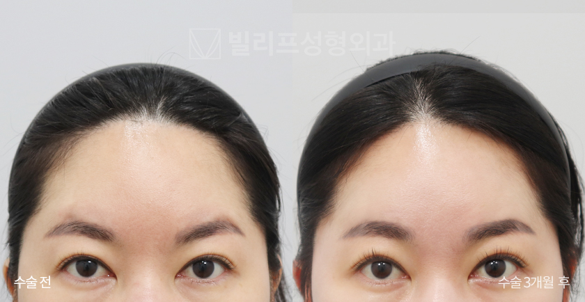Endoscopic Forehead Lift (Endotine) before and after — Vlif Plastic surgery