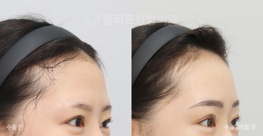 Endoscopic Forehead Lift (Endotine) before and after — Vlif Plastic surgery