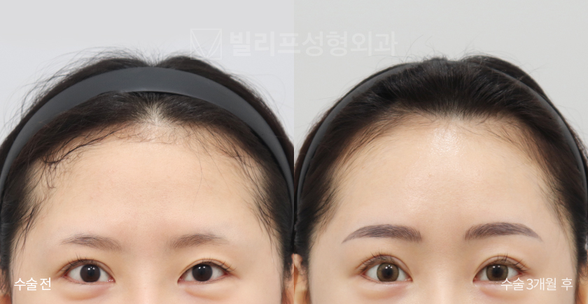 Endoscopic Forehead Lift (Endotine) before and after — Vlif Plastic surgery
