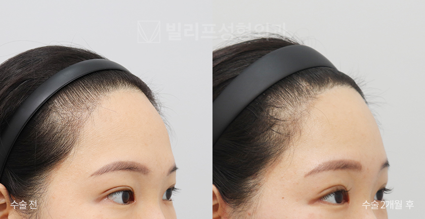 Endoscopic Forehead Lift (Endotine) before and after — Vlif Plastic surgery