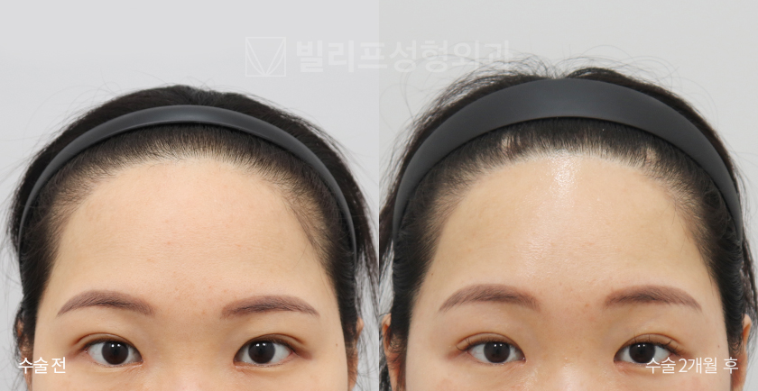 Endoscopic Forehead Lift (Endotine) before and after — Vlif Plastic surgery