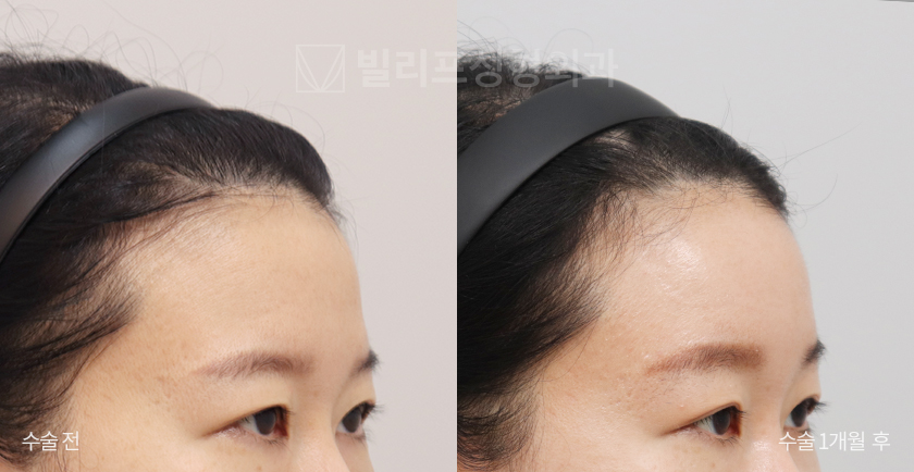 Endoscopic Forehead Lift (Bone Tunneling) before and after — Vlif Plastic surgery