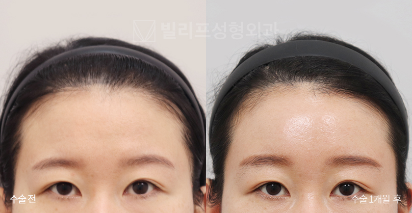 Endoscopic Forehead Lift (Bone Tunneling) before and after — Vlif Plastic surgery