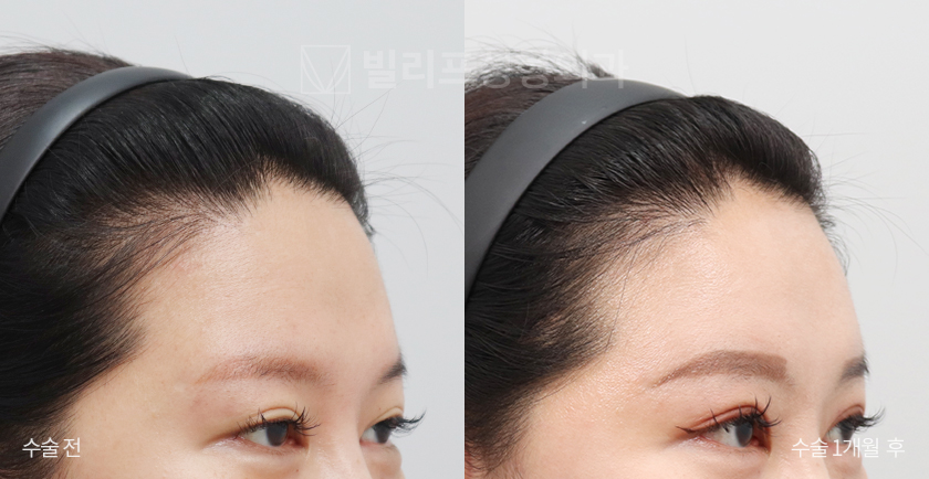 Endoscopic Forehead Lift (Endotine) before and after — Vlif Plastic surgery