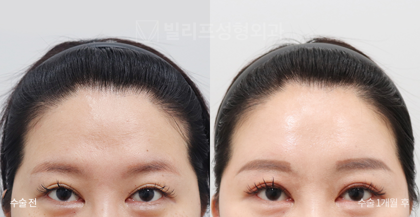Endoscopic Forehead Lift (Endotine) before and after — Vlif Plastic surgery