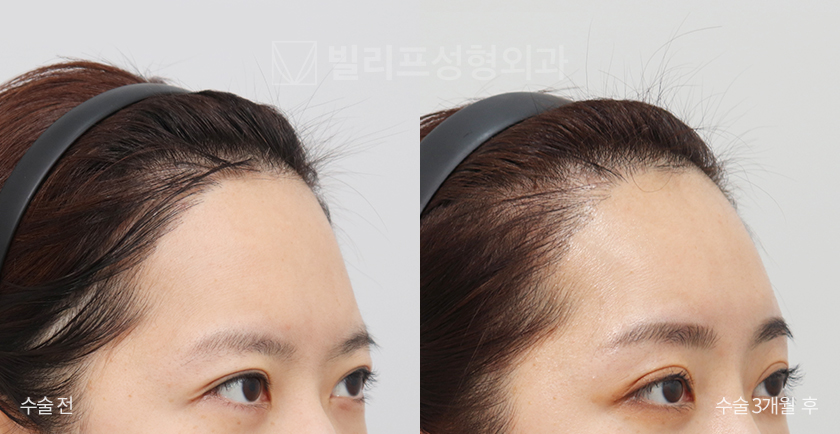 Endoscopic Forehead Lift (Endotine) before and after — Vlif Plastic surgery
