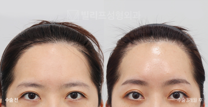 Endoscopic Forehead Lift (Endotine) before and after — Vlif Plastic surgery