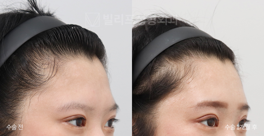 Endoscopic Forehead Lift (Bone Tunneling) before and after — Vlif Plastic surgery