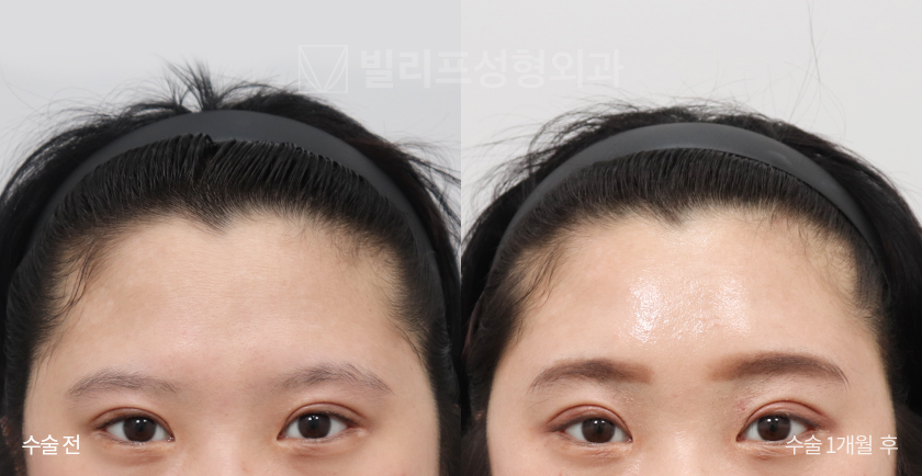 Endoscopic Forehead Lift (Bone Tunneling) before and after — Vlif Plastic surgery