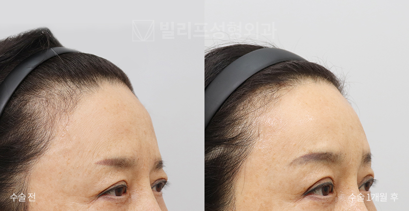 Endoscopic Forehead Lift (Endotine) before and after — Vlif Plastic surgery