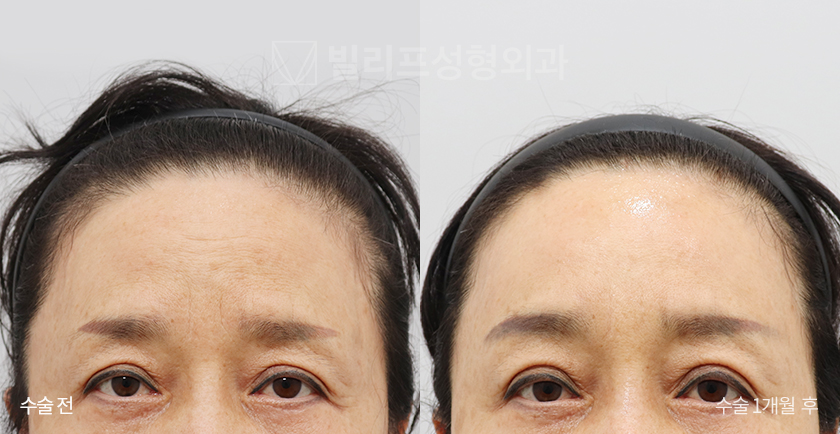 Endoscopic Forehead Lift (Endotine) before and after — Vlif Plastic surgery
