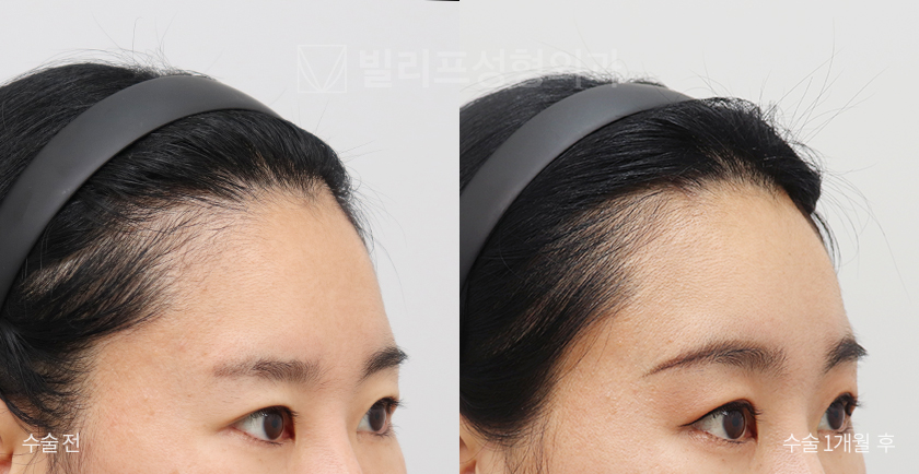 Endoscopic Forehead Lift (Bone Tunneling) before and after — Vlif Plastic surgery