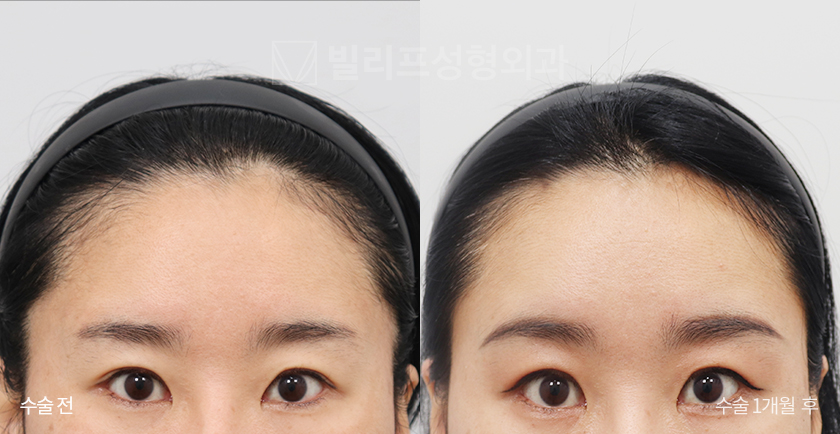 Endoscopic Forehead Lift (Bone Tunneling) before and after — Vlif Plastic surgery