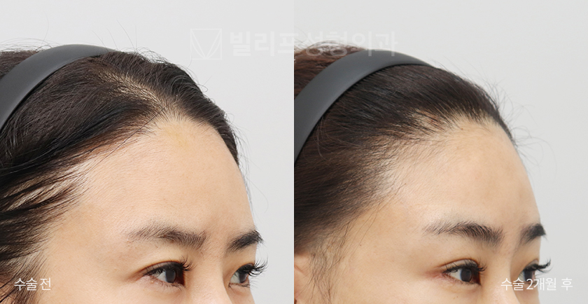 Endoscopic Forehead Lift (Bone Tunneling) before and after — Vlif Plastic surgery